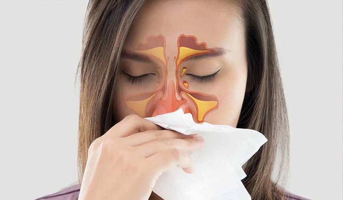 Femeie care suferă de rinită alergică, ținând un șervețel la nas, cu ilustrație a sinusurilor inflamate