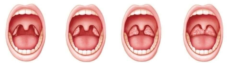 Ilustrație medicală care prezintă evoluția amigdalelor, de la o stare sănătoasă la infecție severă și infecție, evidențiind modificările vizibile în gât