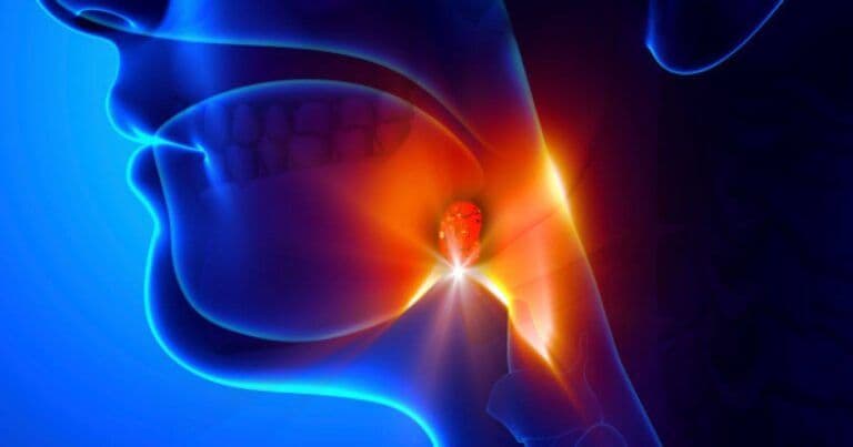 Ilustrație conceptuală 3D a profilului unui pacient, evidențiind o amigdală inflamată în gât cu un efect luminos pentru a sugera durere sau infecție