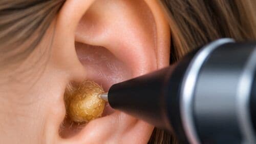 Dop de cerumen care blochează conductul auditiv