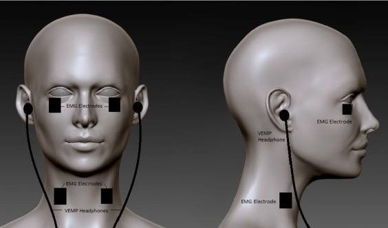 oVEMP (ocular Vestibular Evoked Myogenic Potentials)