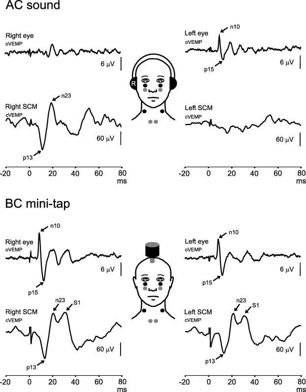 cVEMP ( cervical Vestibular Evoked Myogenic Potentials)