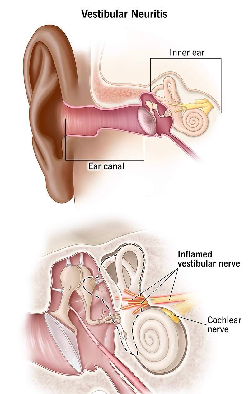 Neuronita vestibulara