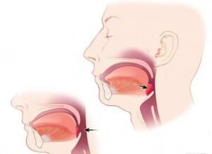 Ilustrație medicală a gâtului uman care arată poziția amigdalelor înainte și după amigdalectomie, evidențiind zona afectată.