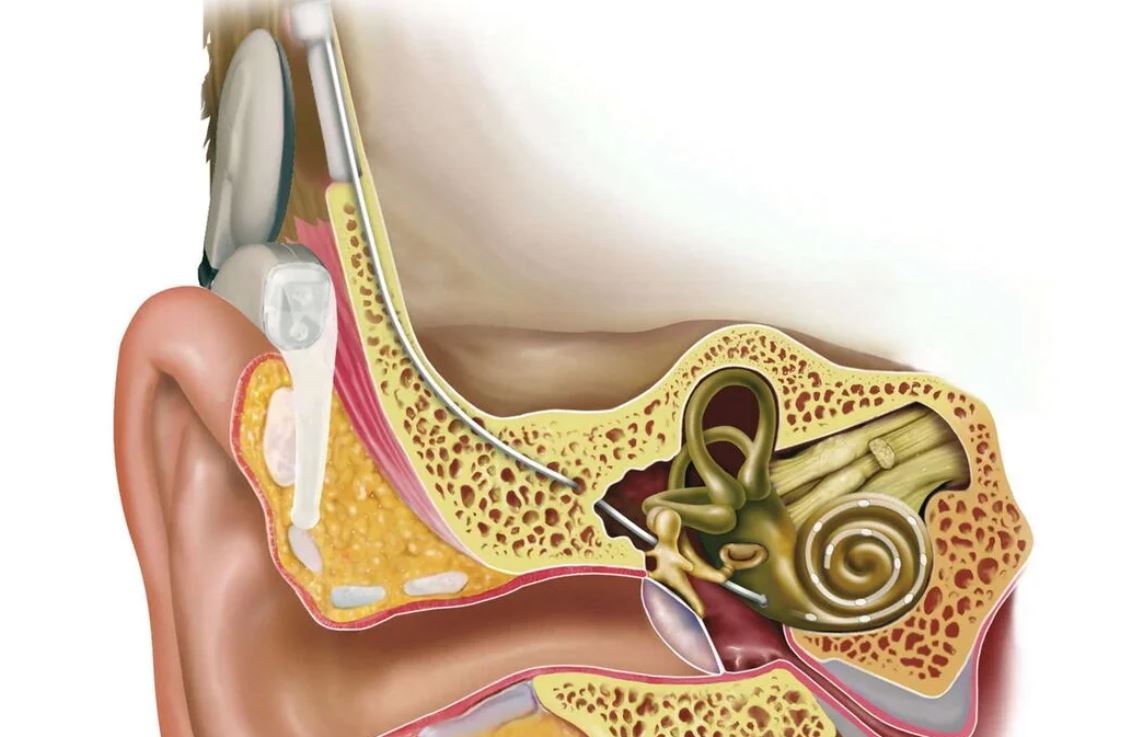 implant cohlear ilustrat în urechea internă, schemă medicală cu nerv auditiv și componentele dispozitivului