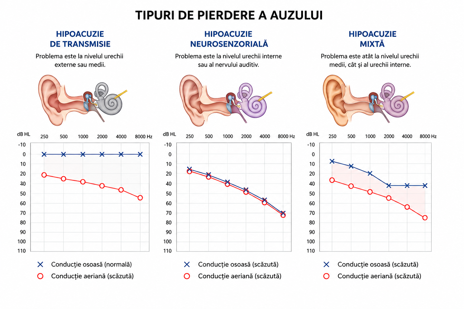 Schema tipurilor de hipoacuzie evidențiate prin audiogramă